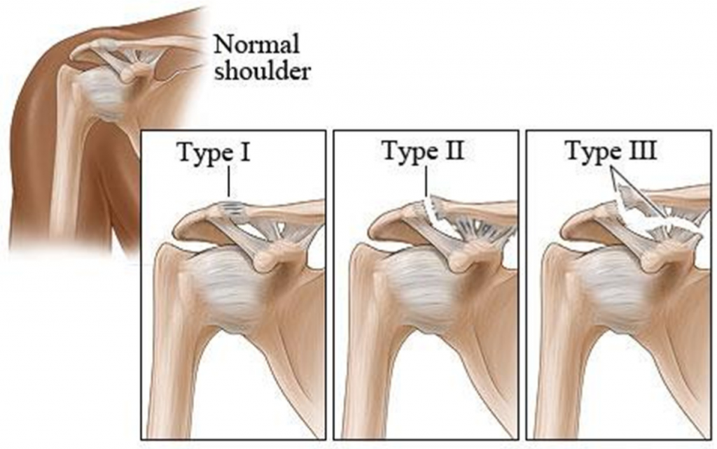 ac joint separation