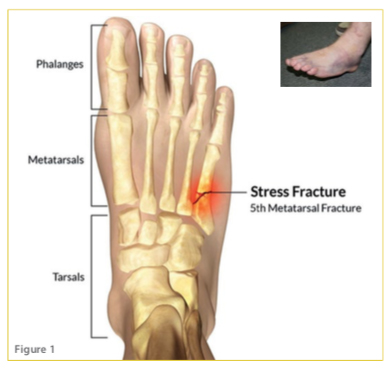 Jones Fracture