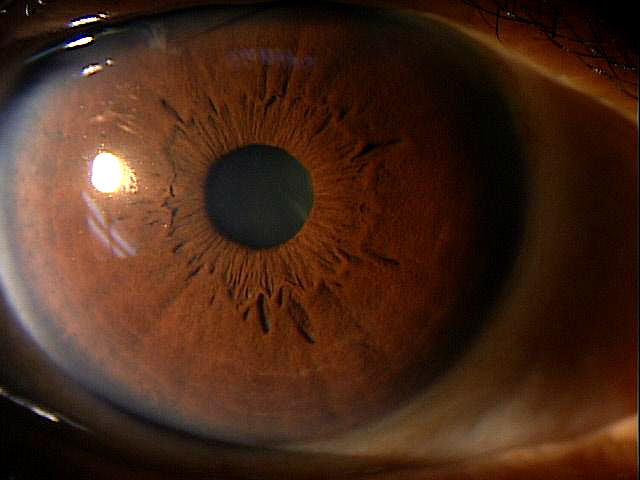 Narrow Angle Glaucoma