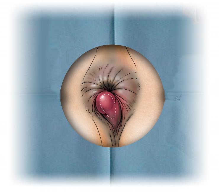 thrombosed hemorrhoid