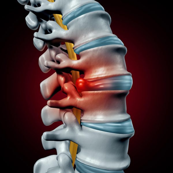 herniated-disc-1 disc herniation